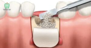 Bone Graft