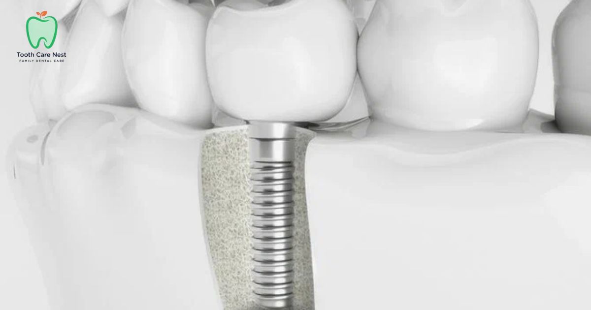 Dental Implants Central Jersey