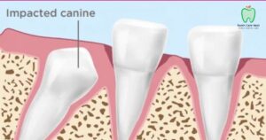 Impacted Canine Extraction