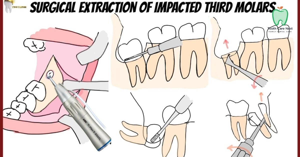 Molar Tooth Extraction