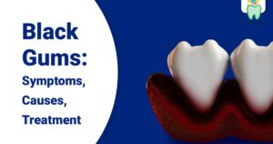Black Gums: Causes, Treatment Options, and Prevention