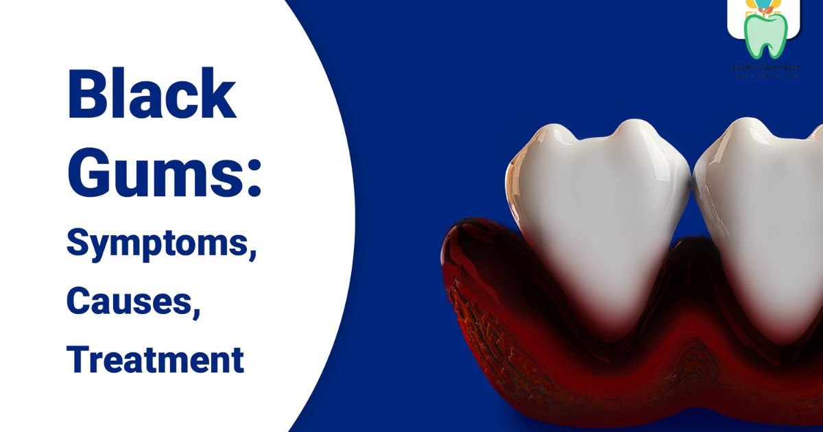 Black Gums: Causes, Treatment Options, and Prevention