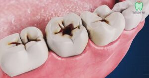 Cavity on Side of Tooth